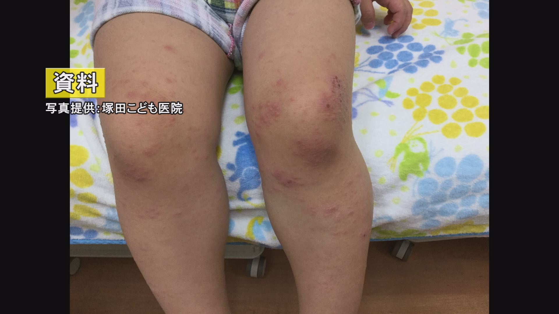 手足口病が流行 警報基準の4倍以上  ヘルパンギーナにも注意